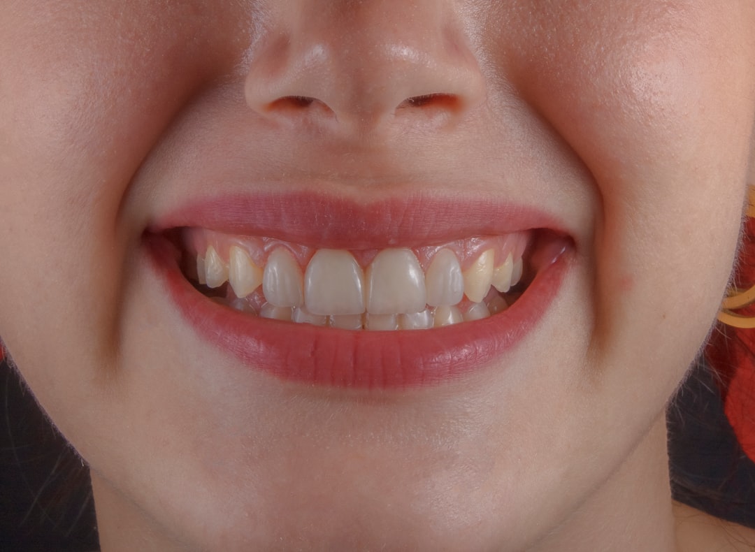 Before and after porcelain veneer transformation showing natural-looking results