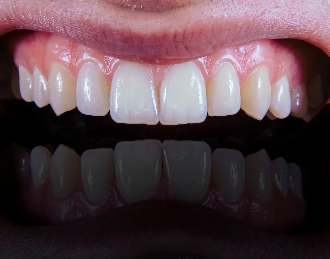 Close-up of porcelain veneer showing natural appearance and craftsmanship