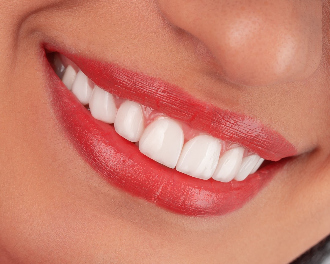Complete smile makeover combining veneers and whitening transformation